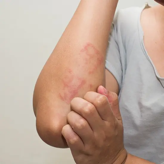 allergy panel, fruit comprehensive panel